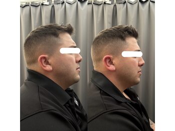 アイアム(I am)/ハイリフトで叶う別人級フェイス