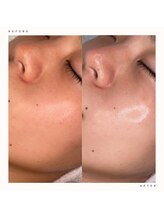 イチロクイチハチ(1618)/肌のごわつきを無くしツヤ肌へ