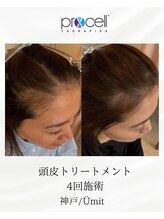 ユミト(Umit)/プロセルスカルプ