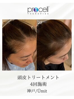 ユミト(Umit)/プロセルスカルプ