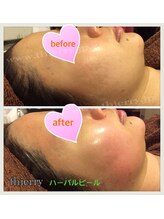 エステティックサロンティエリー/ハーブピーリング