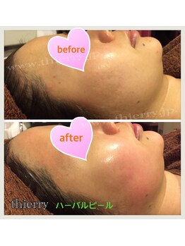 エステティックサロンティエリー/ハーブピーリング