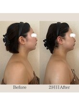 リーブル(LIBRE)/小顔コルギ　２回