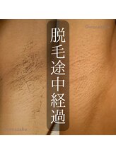 ディオーネ 麻布十番(Dione)/【脱毛】両脇