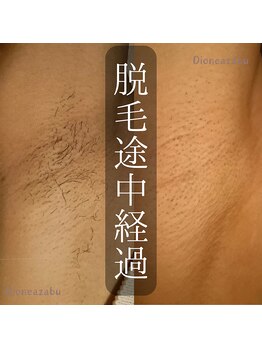 ディオーネ 麻布十番(Dione)/【脱毛】両脇