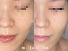 ミエル(mielu)/美白/シミケアプラン