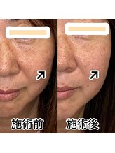 プレシャスワン 越谷店/ほうれい線すっきり美容鍼２００