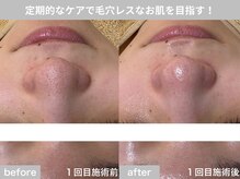 サロン ビュー(salon view)/20代女性〈毛穴黒ずみ悩み〉