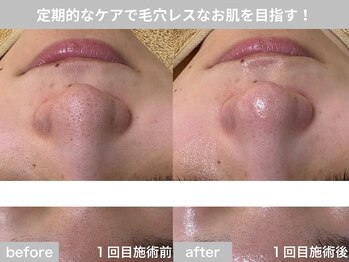 サロン ビュー(salon view)/20代女性〈毛穴黒ずみ悩み〉