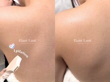 ハニ ラニ(Hani Lani)/人気な背面脱毛メニュー！
