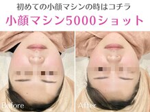 オリエンタルローザ 表参道(Oriental Rosa)/７D小顔リフト5000ショット