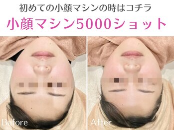 オリエンタルローザ 表参道(Oriental Rosa)/７D小顔リフト5000ショット
