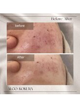 アルゴ 小倉守恒店(ALGO)/大人気韓国エステ！造顔メソッド