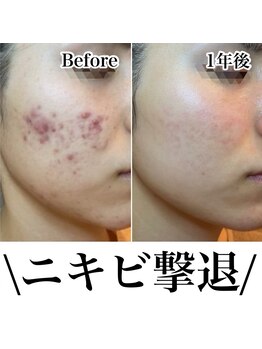 アンドピエル(AndPiel)/ニキビケア！Before After★