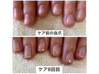 ココモネイル(cocomo nail)/20代看護師さん深爪の悩み