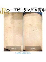 カーラ(cara)/【背中】ハーブピーリング