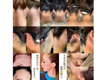 ミーミドットアイ(Mi-mi.i)/うなじ/もみあげワックス脱毛