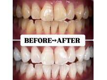 ホワイトニングサロン 豊中/Before&After美白ホワイトニング