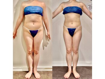 カルナ(CARNA)/【痩身】セルライトゼロ2