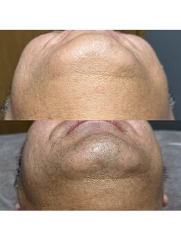 エピノン 山口岩国店(Epinon)/6回 顔脱毛