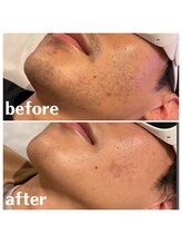 ベイス(BASE)/ヒゲ脱毛BeforeAfter