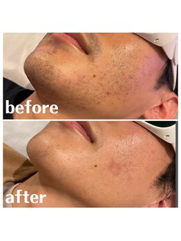 ベイス(BASE)/ヒゲ脱毛BeforeAfter