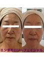 トータルビューティサロン クイーン(Queen)&nbsp;若々しい見た目に返信エンダモロジー、エイジングケア♪