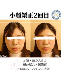 RKY/歪み改善(20代)