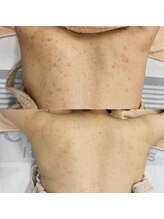 ヴィヴィ(ViVi)/【効果実感！】話題のHAABリプロ