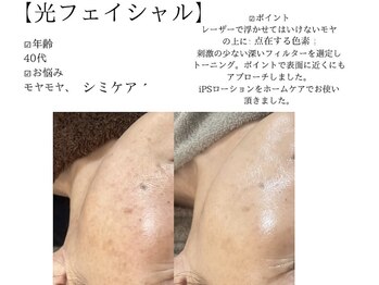 サロンツキ(salon tuki)/光フェイシャル症例/徳島