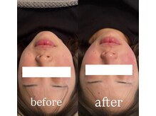 サロン ニコリー(Salon Nicolly)/RED SHOT1回施術before after