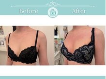 美人バスト 新潟店/ 【バストアップ★育乳】症例