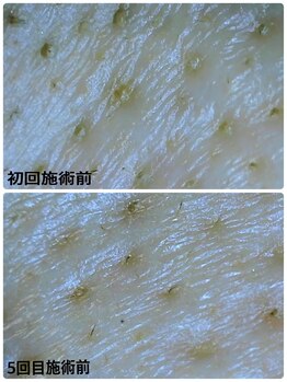 ハーシークレット(Her secret)/ハイドラ毛穴洗浄