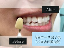 ホワイトニングカフェ アスピア明石店(WhiteningCafe)/◎歯のホワイトニング施術写真◎