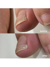 リリ(lili)/巻き爪矯正1回目（左親指）