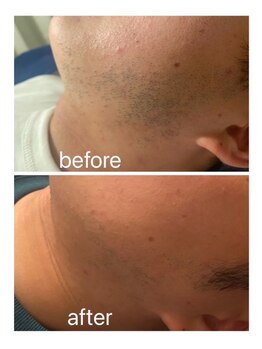 サロンドシェリ(salon de cheri)/ヒゲ脱毛