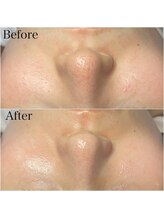 ブラックボックス(BLACK BOX)/新メニュー陶肌ピール