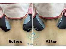 サロンアメリ 高松丸亀町店(Salon Ameri)/香川　高松　うなじ脱毛　アメリ