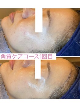 フリーシャ いせさき店(freesha)/【ゆうみ】指名角質ケアコース