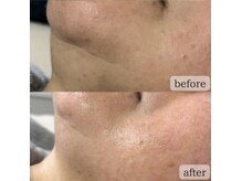 ライリー(Rairy)の雰囲気（【たるみ/シミ/シワ】最強肌質改善！次世代ダ - マプラズマ）