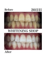 ホワイトニングショップ 西尾店/Before&After　20日目のお客様