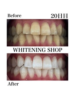 ホワイトニングショップ 西尾店/Before&After 20日目のお客様