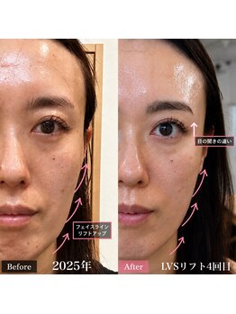 クレール(clair)の写真/【40代からの肌・たるみケア◎】LVSリフトで、年齢とともに気になるお顔のお悩みをケア