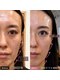 クレール(clair)の写真/【40代からの肌・たるみケア◎】LVSリフトで、年齢とともに気になるお顔のお悩みをケア