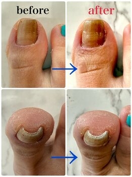 ネイルベース ネイル ケア サロン ミウラ(miura)/【巻き爪解放】レジスタンス