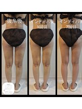 アリビオ(ALIVIO)/美容施術前後ケア