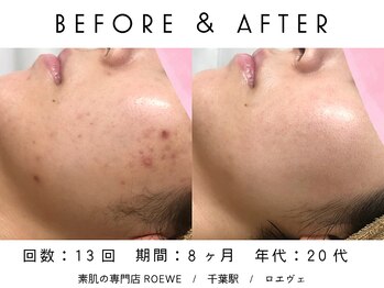 ロエヴェ(ROEWE)/ニキビ改善・毛穴ケア・肌質改善