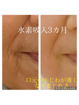 ヨサパーク アミカル 八幡山店(YOSAPARK amical)/水素吸入の威力が凄い！！