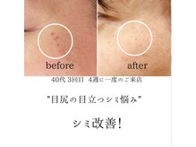 シミリセット 名駅(シミReset)/気になるシミも目立たない