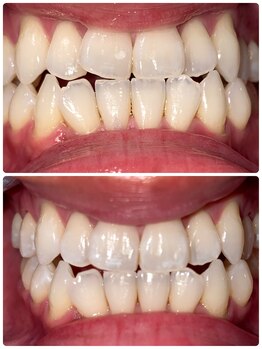 コントレール 歯ぁと(CONTRAIL)/日々のケアとホワイトニング週１
